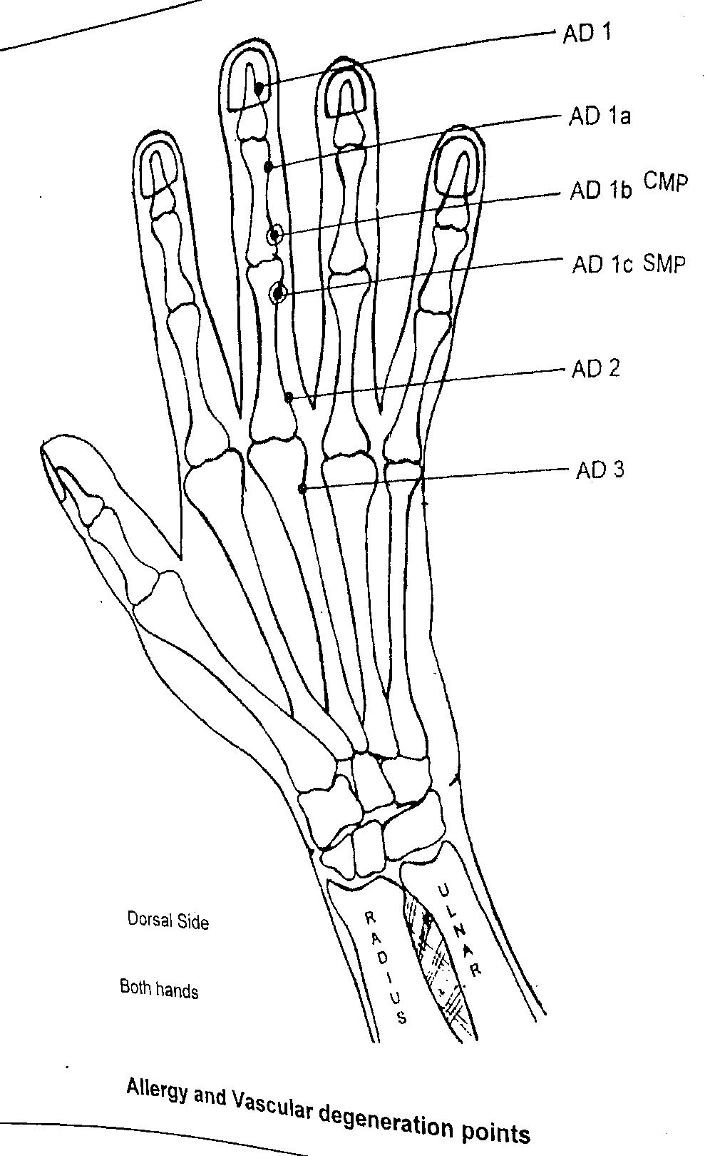 Diagram of the dorsal side of the hand showing the Allergy and Vascular Degeneration points AD1, AD1a, AD1b (CMP), AD1c (SMP), AD2 and AD3