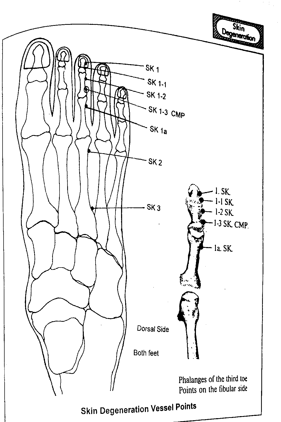 Diagram of the dorsal side of the foot showing Skin Degeneration Vessel points SK1, SK1-1, SK1-2, SK1-3 (CMP), SK1a, SK2 and SK3, with an inset detail of the phalanges of the third toe on the fibular side